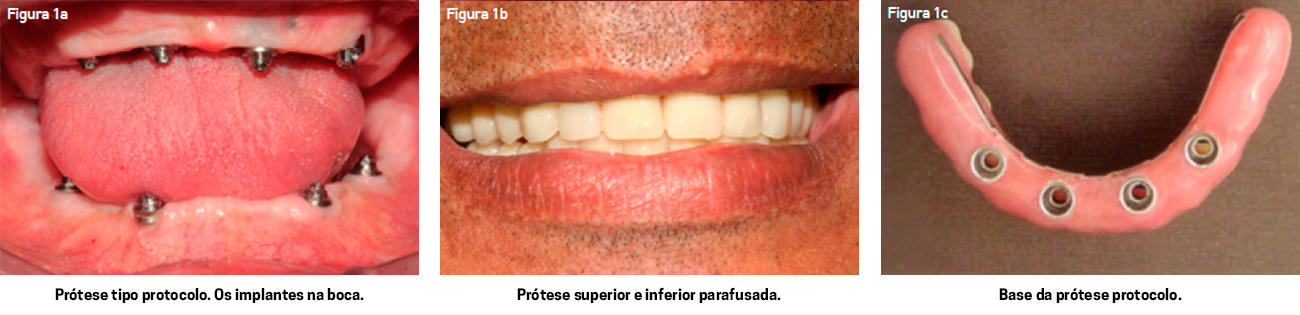 Planejamento Protético de Overdenture - Dental Family