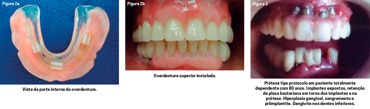 Planejamento Protético de Overdenture - Dental Family